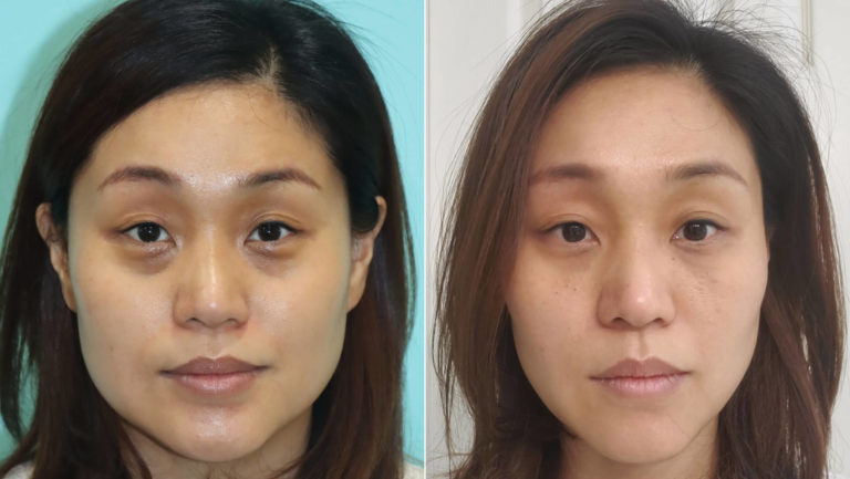 Botox and filler